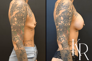 Breast augmentation before and after photo, side view