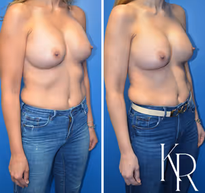 Breast augmentation revision before and after photo, front view
