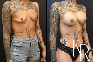 Breast augmentation before and after photo, front view