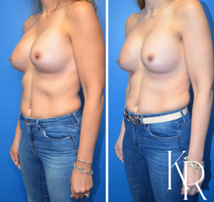 Breast augmentation revision before and after photo, front view