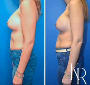 Breast augmentation revision before and after photo, side view
