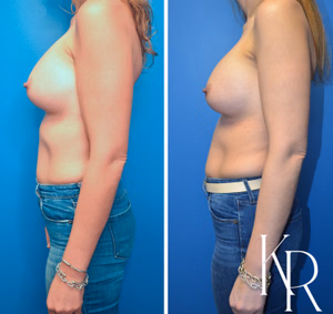 Breast augmentation revision before and after photo, side view