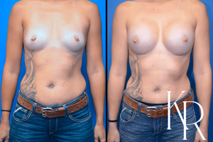 Breast augmentation before and after photo, front view