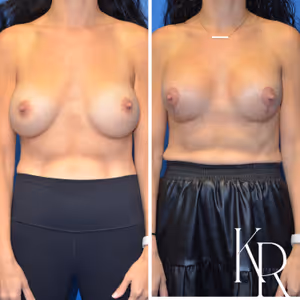 Breast augmentation revision before and after photo, front view