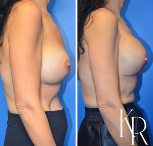 Breast augmentation revision before and after photo, side view