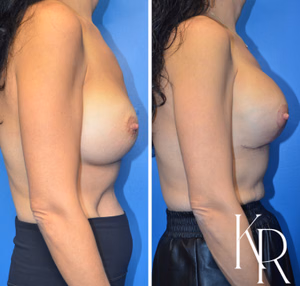 Breast augmentation revision before and after photo, side view