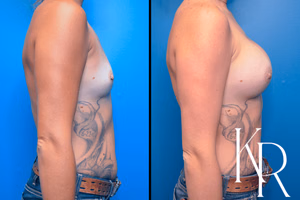 Breast augmentation before and after photo, side view