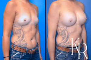 Breast augmentation before and after photo, front view
