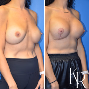 Breast augmentation revision before and after photo, front view
