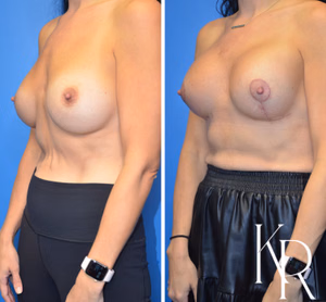 Breast augmentation revision before and after photo, front view