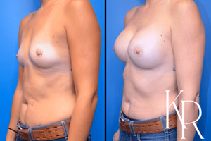 Breast augmentation before and after photo, front view