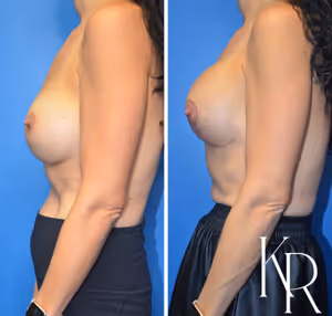 Breast augmentation revision before and after photo, side view