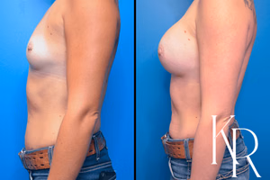 Breast augmentation before and after photo, side view