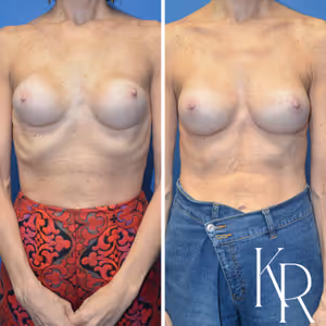 Breast augmentation revision before and after photo, front view