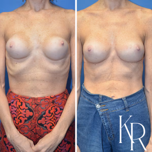Breast augmentation revision before and after photo, front view