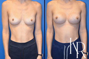 Breast augmentation before and after photo, front view