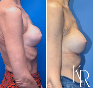 Breast augmentation revision before and after photo, side view