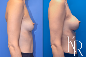 Breast augmentation before and after photo, side view