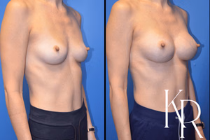 Breast augmentation before and after photo, front view