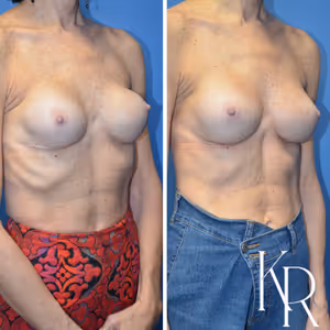 Breast augmentation revision before and after photo, front view