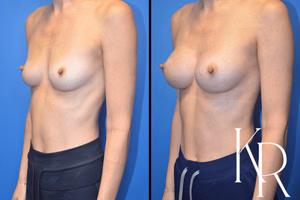 Breast augmentation before and after photo, front view
