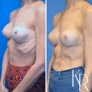 Breast augmentation revision before and after photo, front view