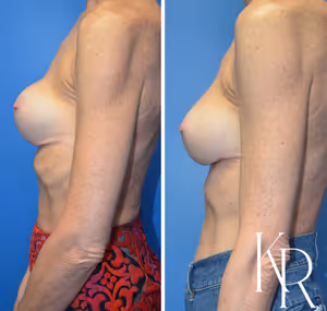 Breast augmentation revision before and after photo, side view