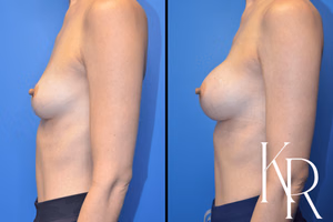 Breast augmentation before and after photo, side view