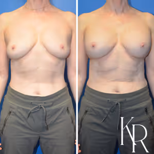 Breast augmentation revision before and after photo, front view