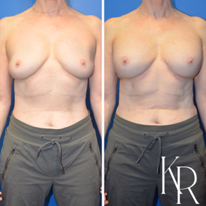 Breast augmentation revision before and after photo, front view
