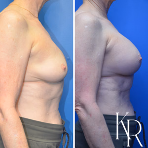 Breast augmentation revision before and after photo, side view