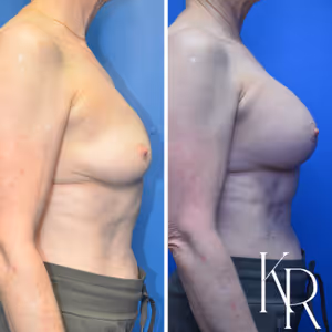 Breast augmentation revision before and after photo, side view