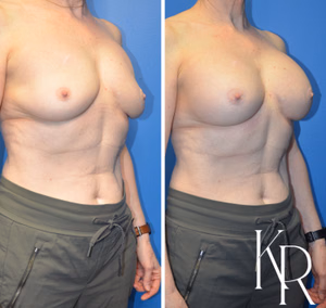Breast augmentation revision before and after photo, front view