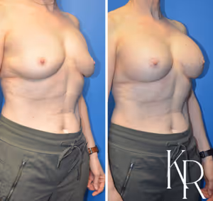 Breast augmentation revision before and after photo, front view