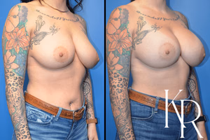 Breast augmentation before and after photo, front view