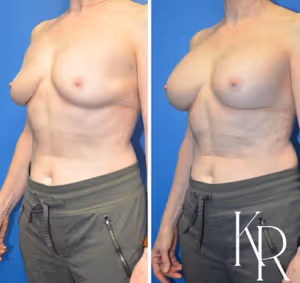 Breast augmentation revision before and after photo, front view