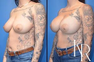 Breast augmentation before and after photo, front view