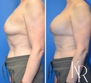 Breast augmentation revision before and after photo, side view