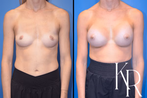 Breast augmentation before and after photo, front view