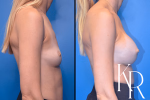 Breast augmentation before and after photo, side view