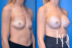 Breast augmentation before and after photo, front view