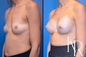 Breast augmentation before and after photo, front view