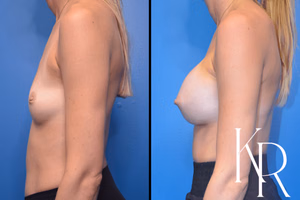 Breast augmentation before and after photo, side view
