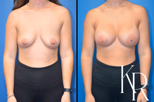 Breast augmentation before and after photo, front view