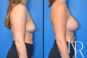 Breast augmentation before and after photo, side view