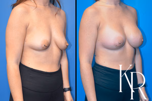 Breast augmentation before and after photo, front view