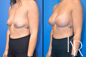 Breast augmentation before and after photo, front view