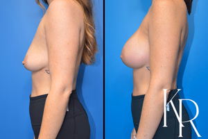 Breast augmentation before and after photo, side view