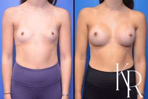 Breast augmentation before and after photo, front view