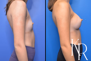 Breast augmentation before and after photo, side view